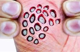 Image result for What Skin Disese Looks Like a Lotus Seed Pod