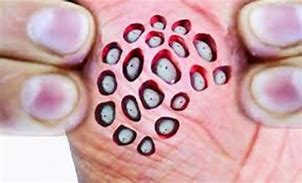 Image result for Human Lotus Pod Skin Disease