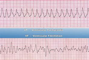 Image result for Ventricular Tachycardia