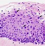 Image result for Squamous Dysplasia