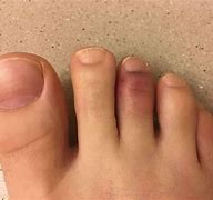 Image result for Broken Big Toe