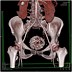 Image result for Calcified Fibroid Uterus