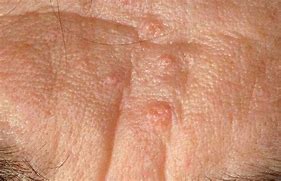 Image result for Bumps All Over Skin Disease