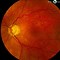 Image result for Full Thickness Macular Hole