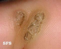 Image result for What Causes Skin Warts