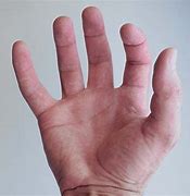 Image result for Claw-Like Hands