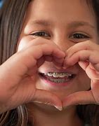 Image result for Braces for Kids