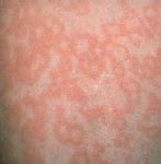 Image result for Fifth Disease Rash Baby
