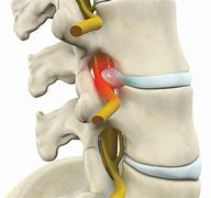 Image result for Lumbar Radiculopathy Nerve Root