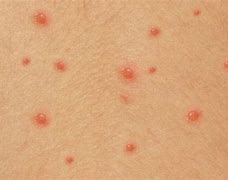 Image result for Molluscum Contagiosum Virus Pox