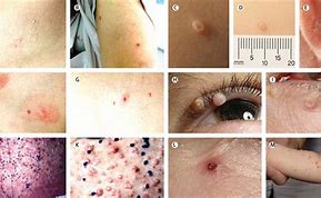 Image result for Molluscum Infection