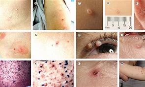 Image result for Molluscum Contagiosum Infection Stages