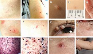 Image result for Molluscum Contagiosum in Adults Scarring