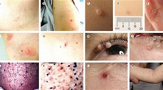 Image result for Severe Molluscum Contagiosum