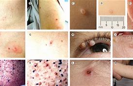 Image result for HPV Warts vs Molluscum