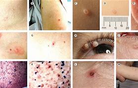 Image result for Molluscum Contagiosum Face