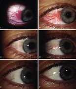 Image result for Eye Conjunctival Papilloma