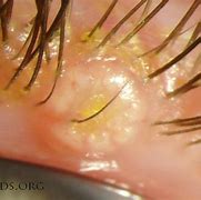 Image result for Pictures of Molluscum Healing