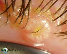Image result for Best Treatment for Molluscum