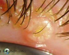 Image result for Molluscum Removal Treatment