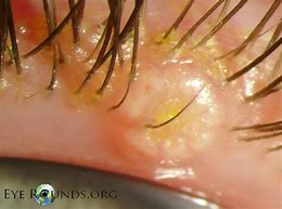 Image result for Molluscum Contagiosum Infection Treatment