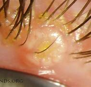 Image result for All Natural Molluscum Treatment