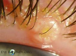Image result for Molluscum On Hands