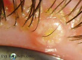 Image result for Molluscum Skin Condition
