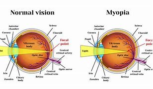 Image result for Myopia Drawing