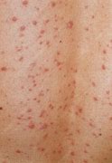 Image result for Diagnose Skin Rash