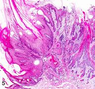 Image result for Viral Papilloma