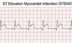 Image result for STEMI Myocardial Infarction