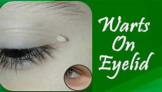 Image result for Little Wart On Eyelid