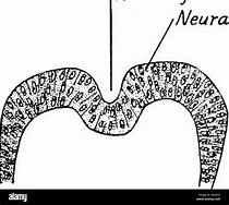 Image result for Anencephaly Neural Tube