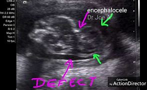 Image result for Encephalocele Ultrasound