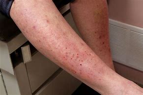 Image result for Allergy Rash Legs