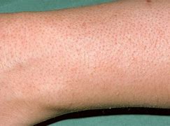 Image result for Acne On Forearms
