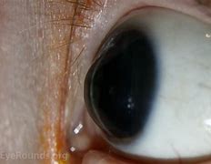 Image result for Keratoconus Scarring