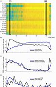 Image result for Multiple Spikes EEG