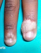 Image result for Types of Finger Warts