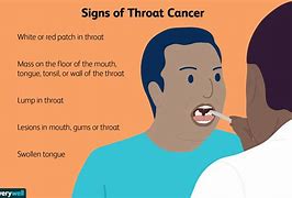 Image result for signs throat cancers