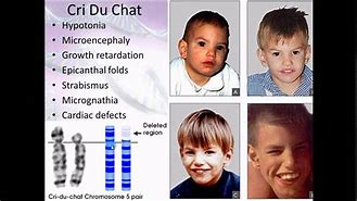 Image result for Female Genetic Defects