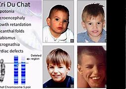 Image result for Chromosome Disorders