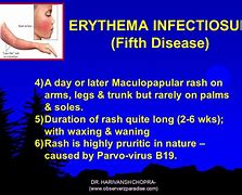 Image result for Fifth Disease Rash On Arms