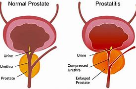 Image result for Prostatitis vs Prostatism