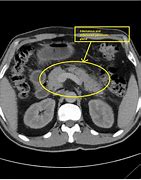 Image result for Pancreatitis MRI