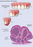 Image result for Gingival Pyogenic Granuloma