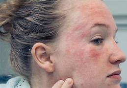 Image result for Dermatitis Rash On Face