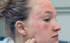 Image result for Red Skin Rash On Face