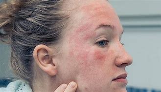 Image result for Eczema Rash On Face